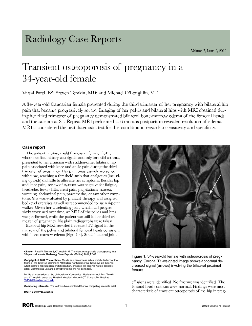 Transient osteoporosis of pregnancy in a 34-year-old female