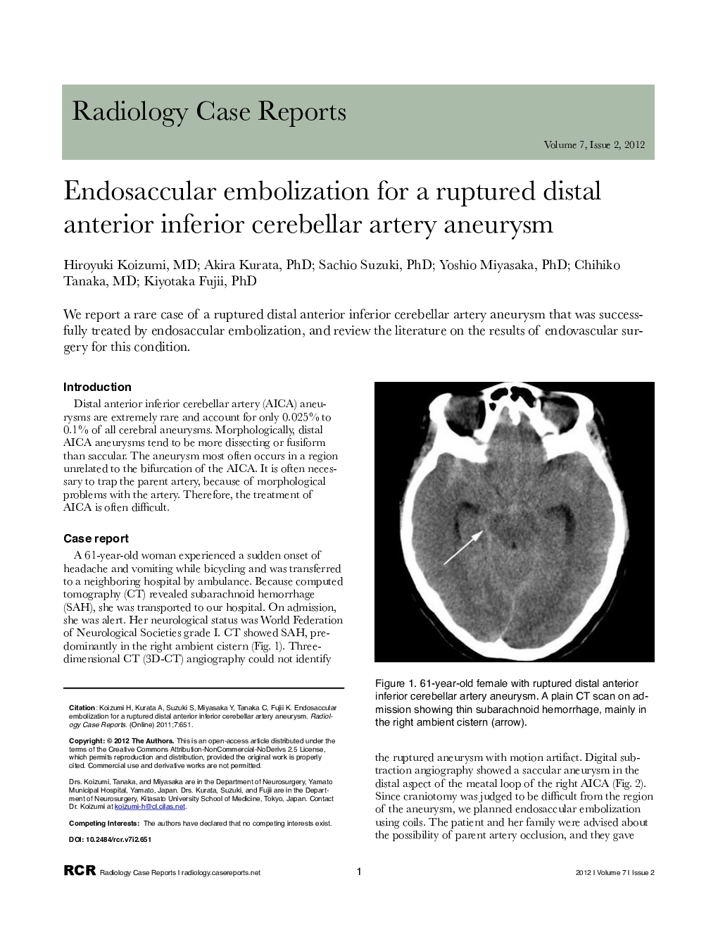 Endosaccular embolization for a ruptured distal anterior inferior cerebellar artery aneurysm