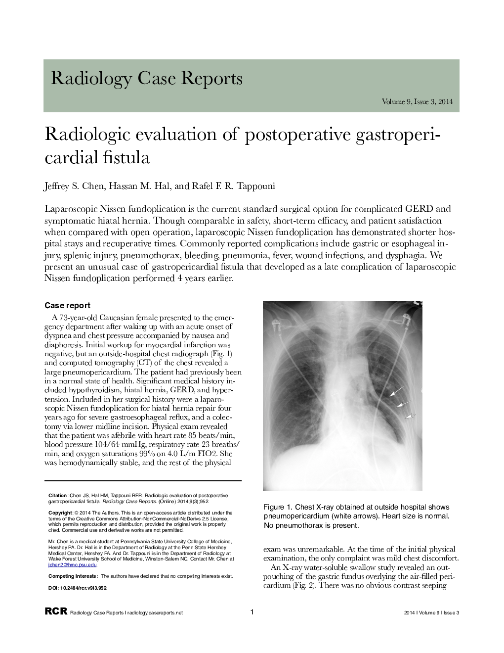 Radiologic evaluation of postoperative gastropericardial fistula