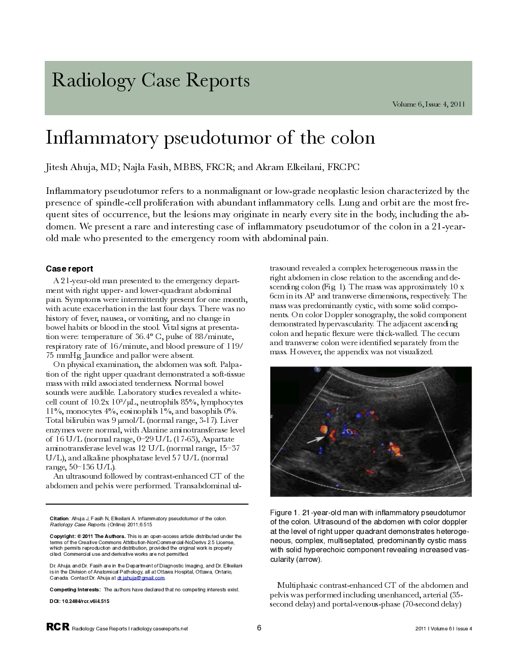 Inflammatory pseudotumor of the colon