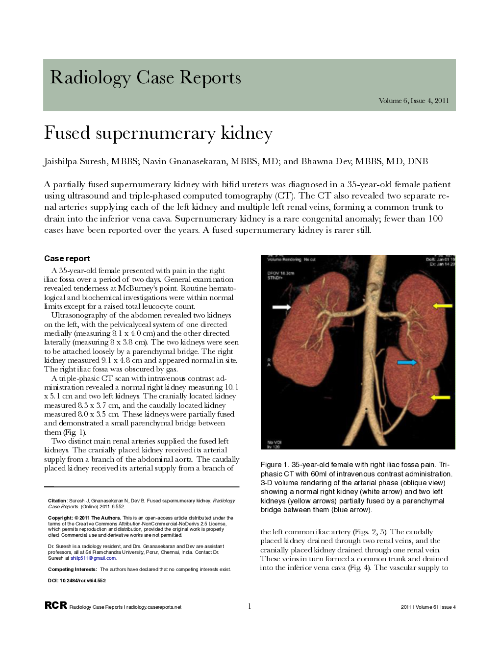 Fused supernumerary kidney