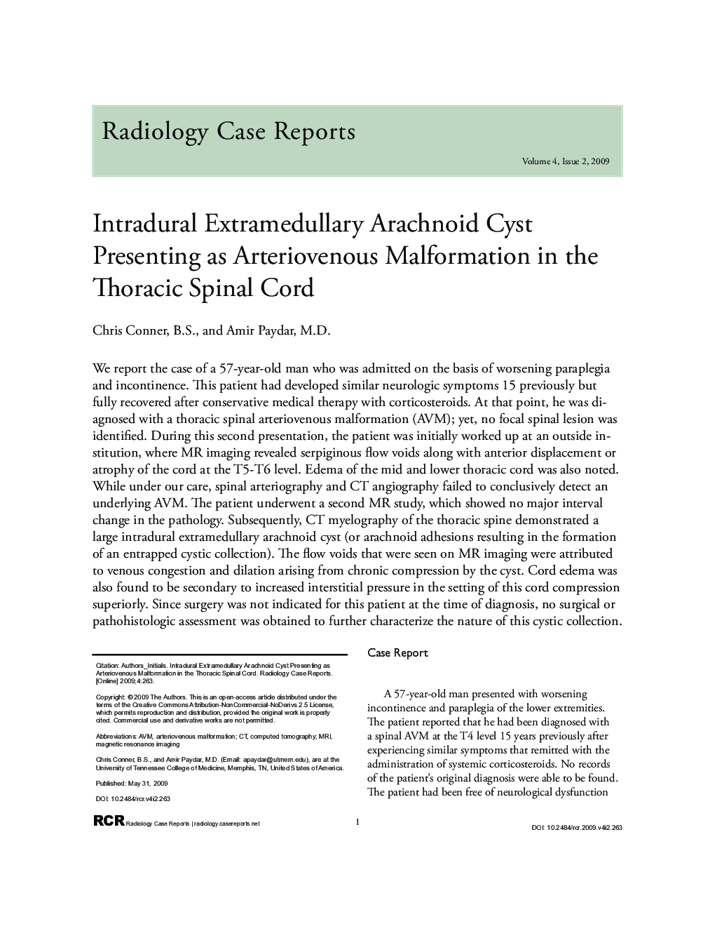 Intradural Extramedullary Arachnoid Cyst Presenting as Arteriovenous Malformation in the Thoracic Spinal Cord