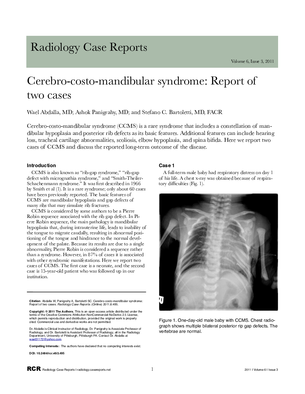 Cerebro-costo-mandibular syndrome: Report of two cases