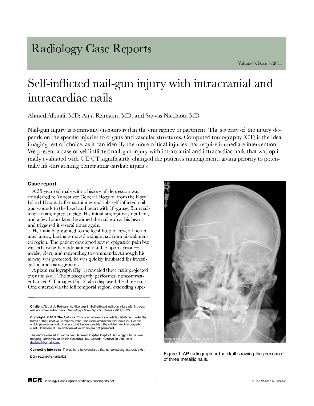 Self-inflicted nail-gun injury with intracranial and intracardiac nails