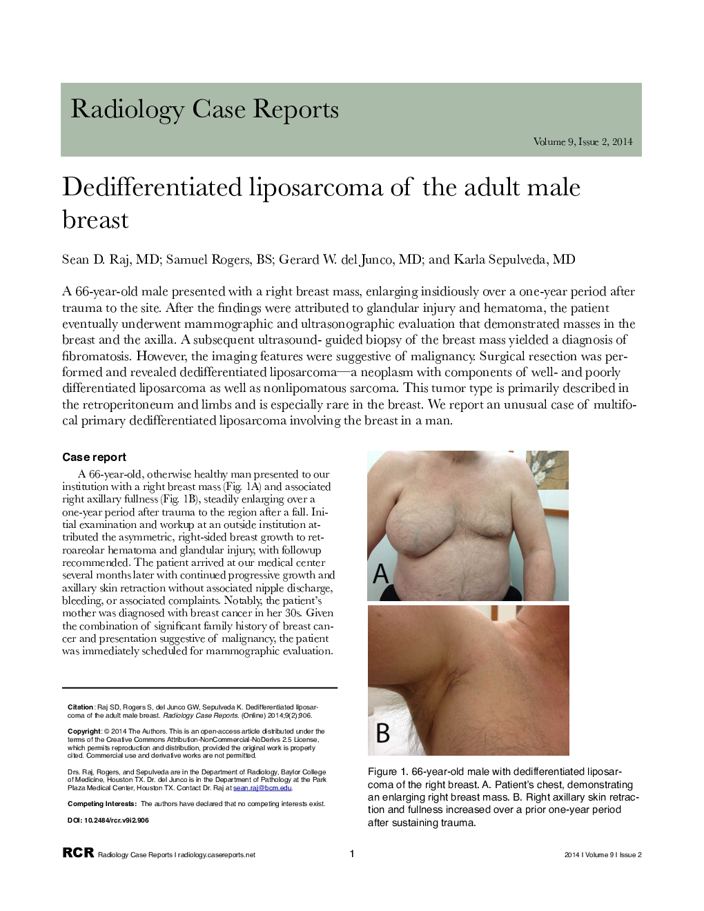 Dedifferentiated liposarcoma of the adult male breast