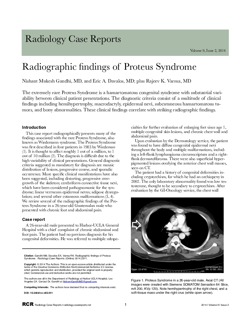 Radiographic findings of Proteus Syndrome