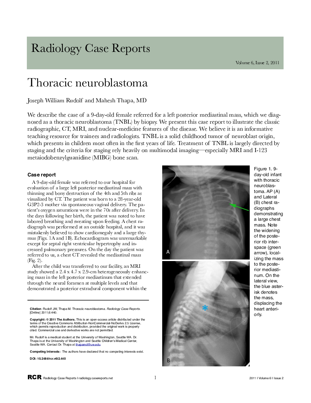 Thoracic neuroblastoma