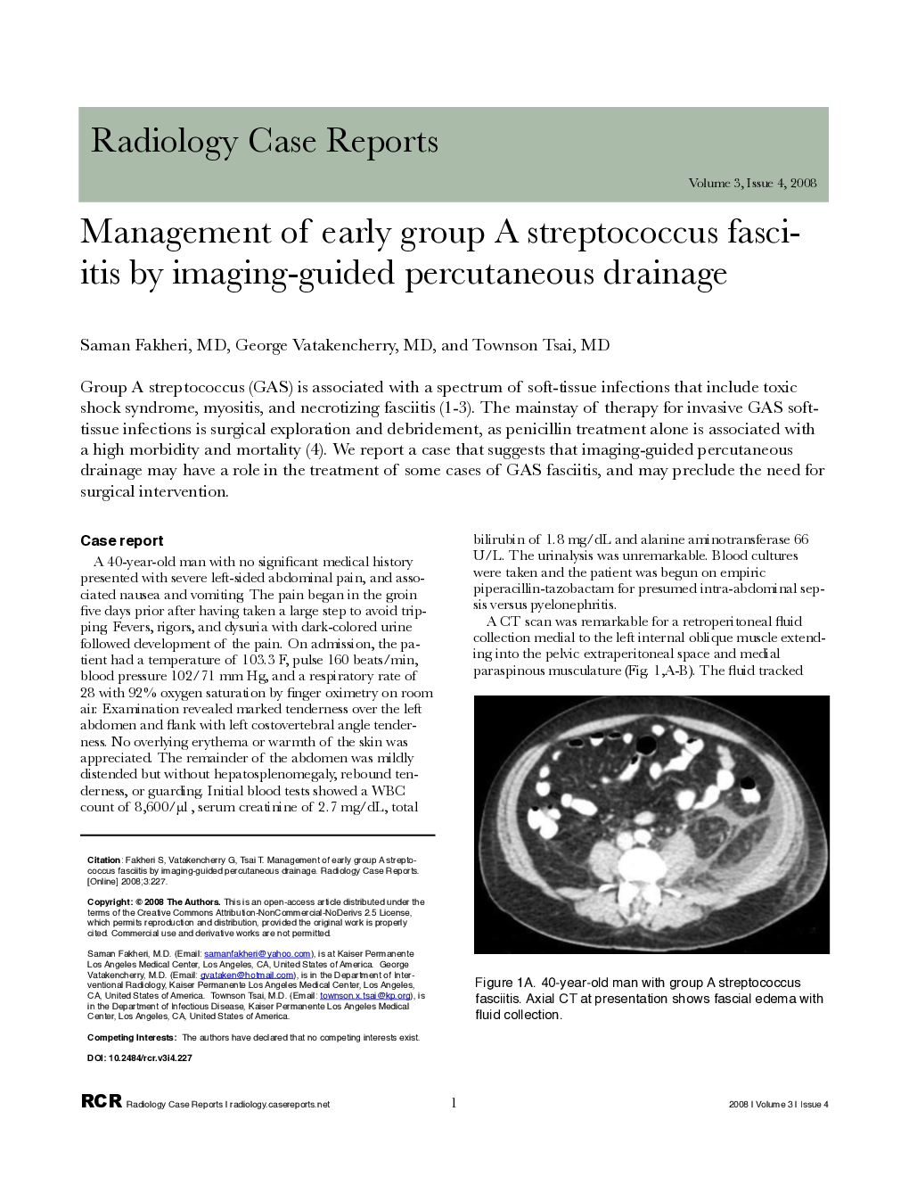 Management of early group A streptococcus fasciitis by imaging-guided percutaneous drainage