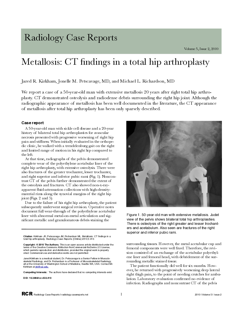 Metallosis: CT findings in a total hip arthroplasty