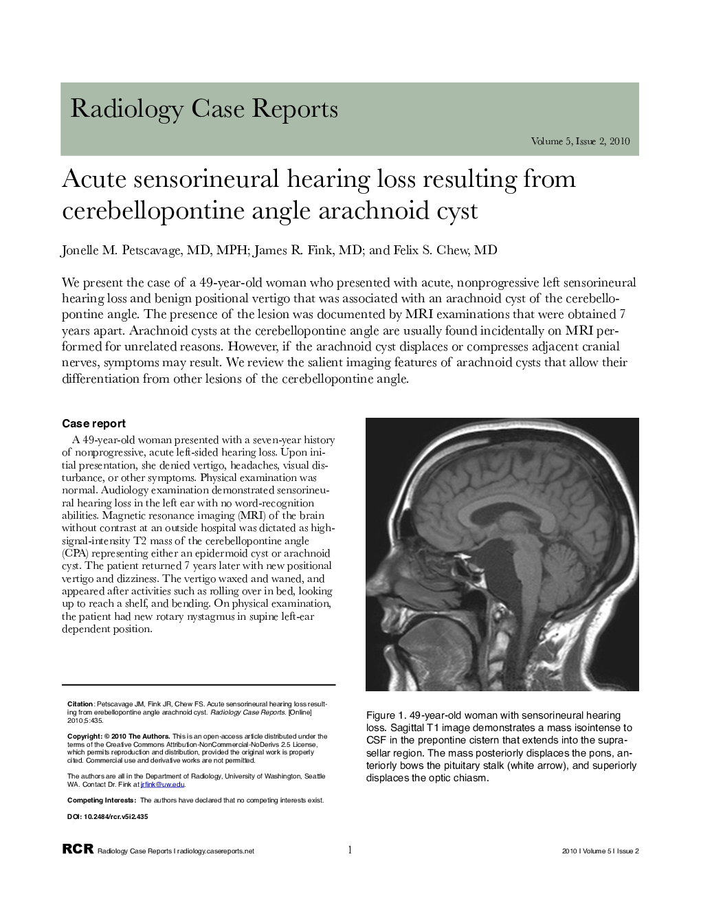 Acute sensorineural hearing loss resulting from cerebellopontine angle arachnoid cyst