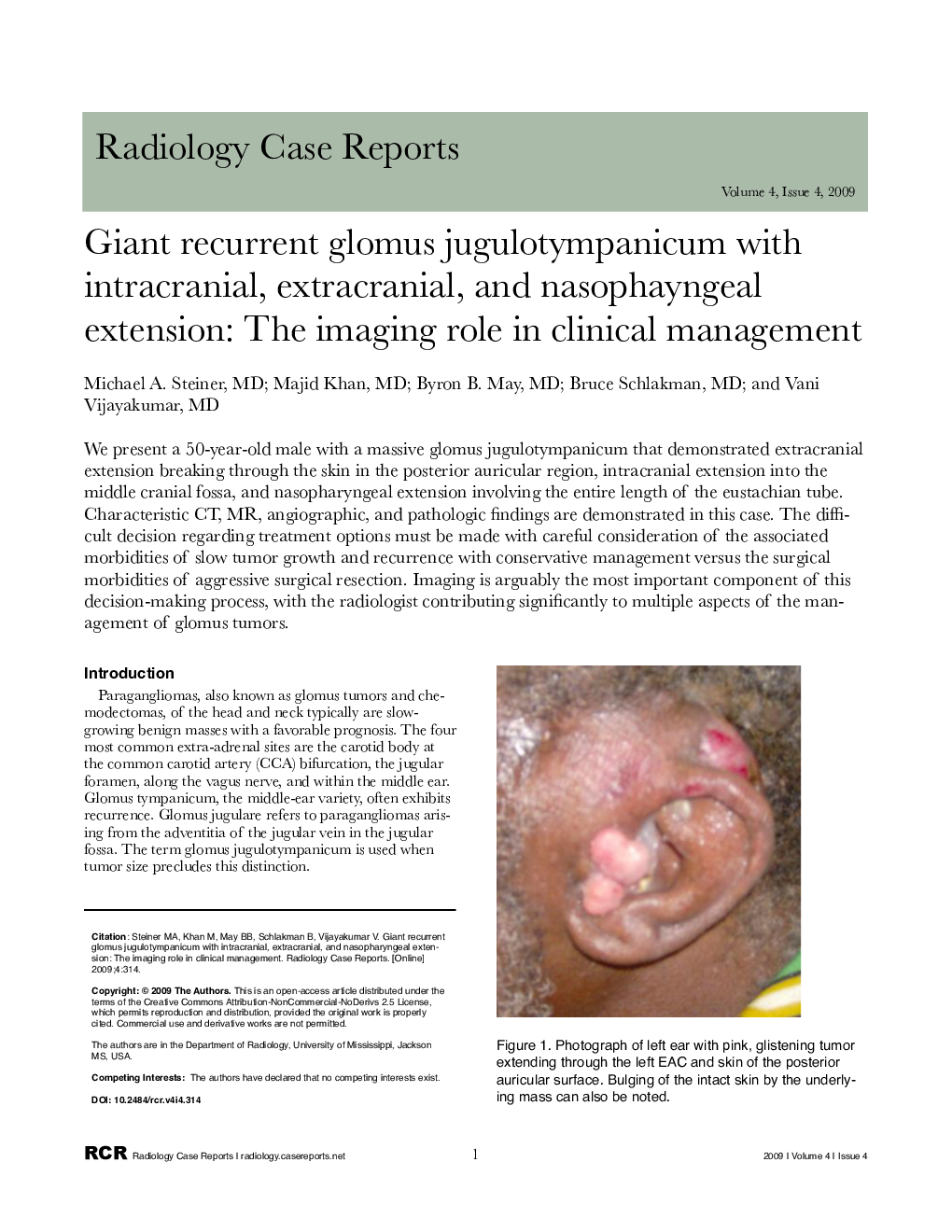 Giant recurrent glomus jugulotympanicum with intracranial, extracranial, and nasophayngeal extension: The imaging role in clinical management