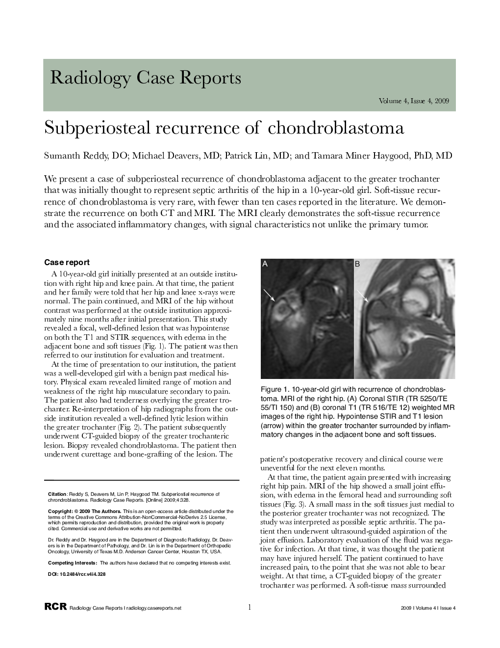 Subperiostial recurrence of chondroblastoma