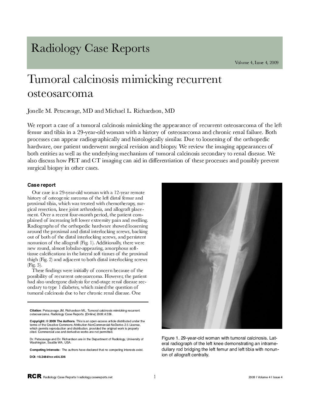 Tumoral calcinosis mimicking recurrent osteosarcoma