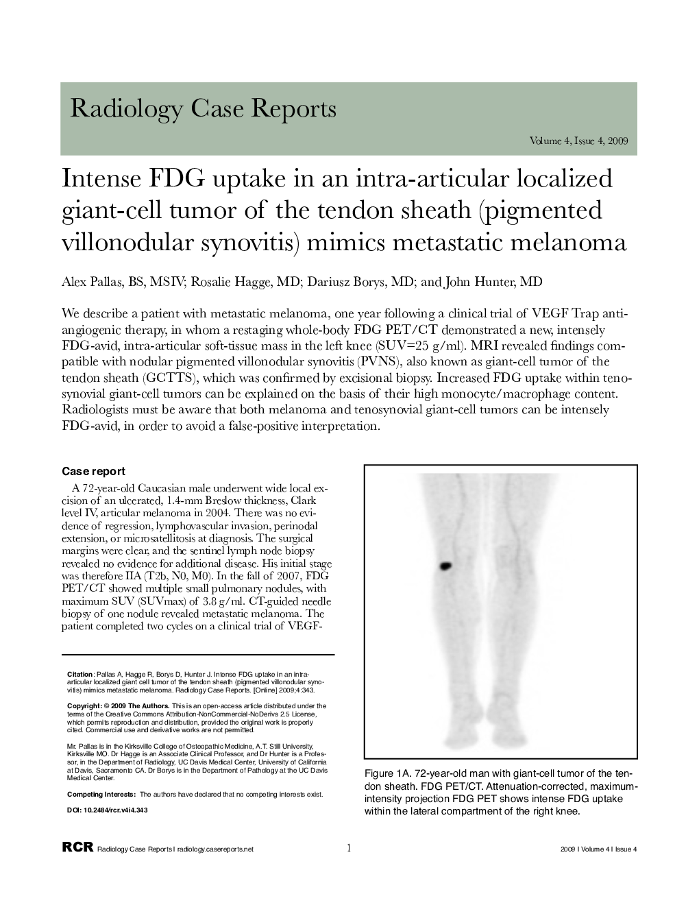 Intense FDG uptake in an intra-articular localized giant-cell tumor of the tendon sheath (pigmented villonodular synovitis) mimics metastatic melanoma