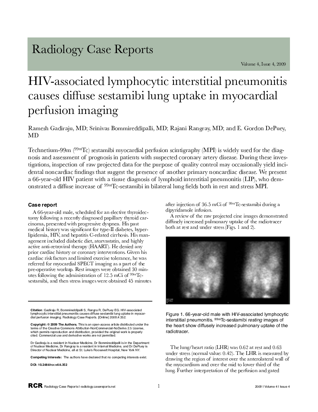 HIV-associated lymphocytic interstitial pneumonitis causes diffuse sestamibi lung uptake in myocardial perfusion imaging