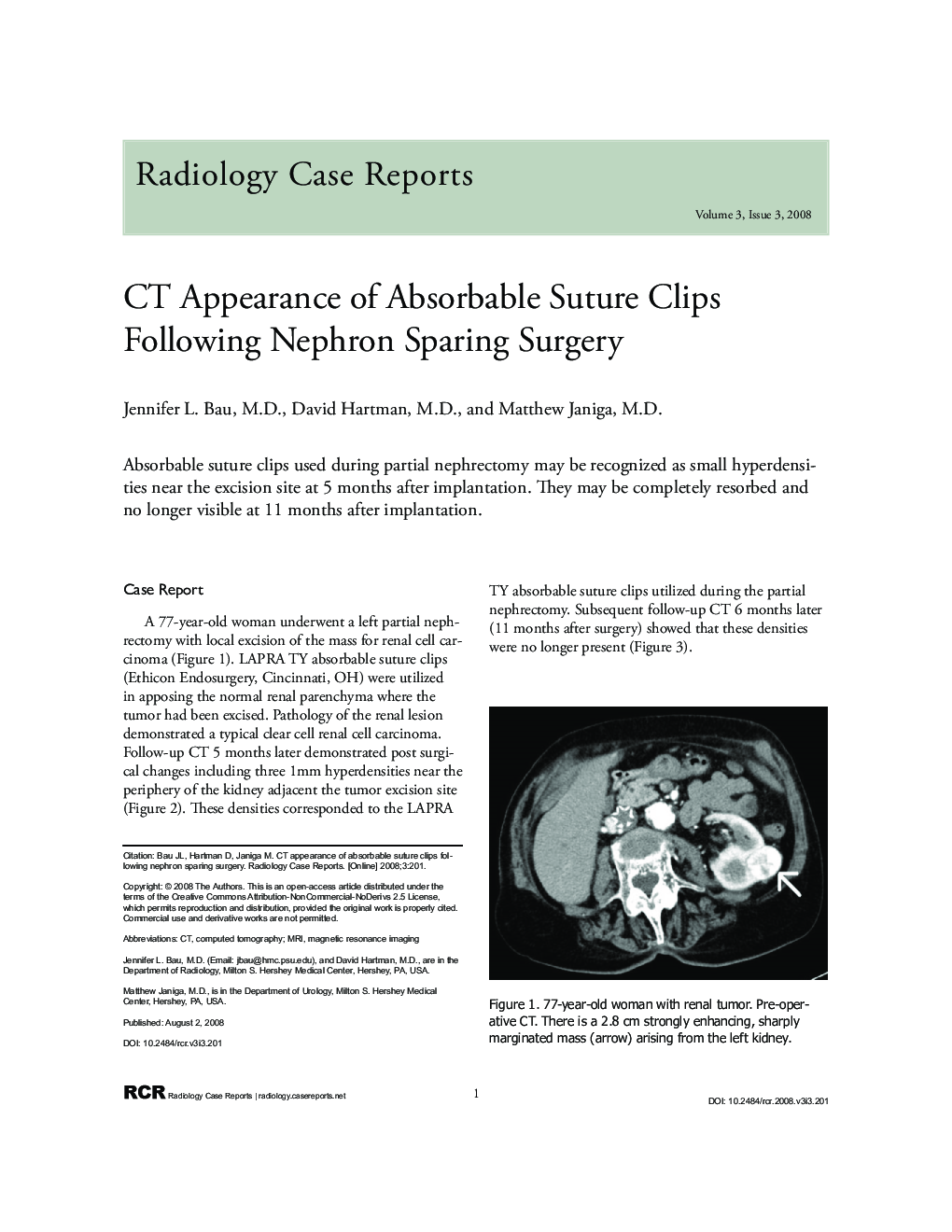 CT Appearance of Absorbable Suture Clips Following Nephron Sparing Surgery