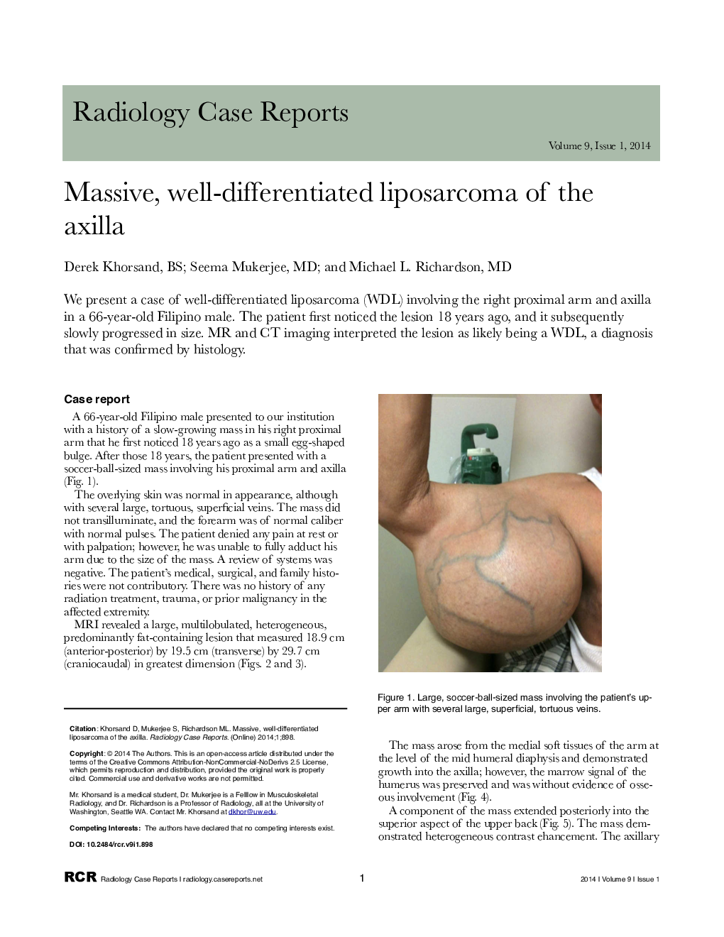 Massive, well-differentiated liposarcoma of the axilla