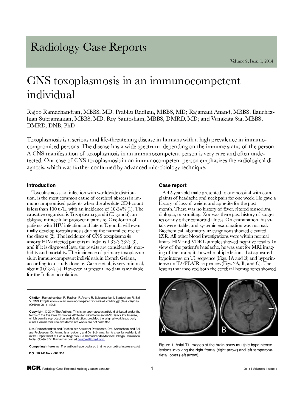 CNS toxoplasmosis in an immunocompetent individual