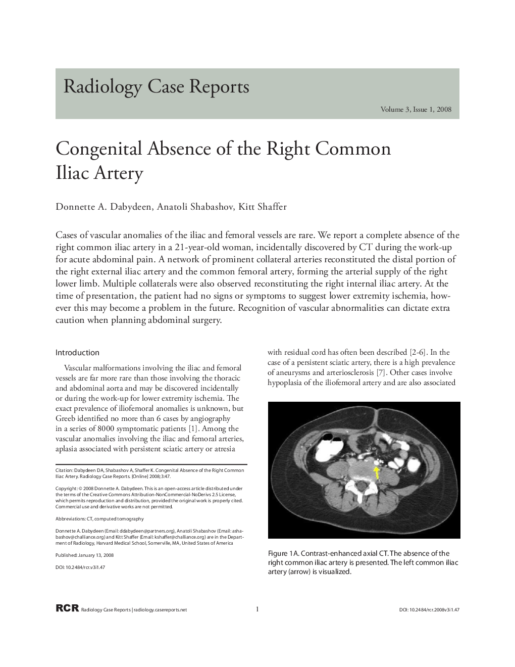 Congenital Absence of the Right Common Iliac Artery