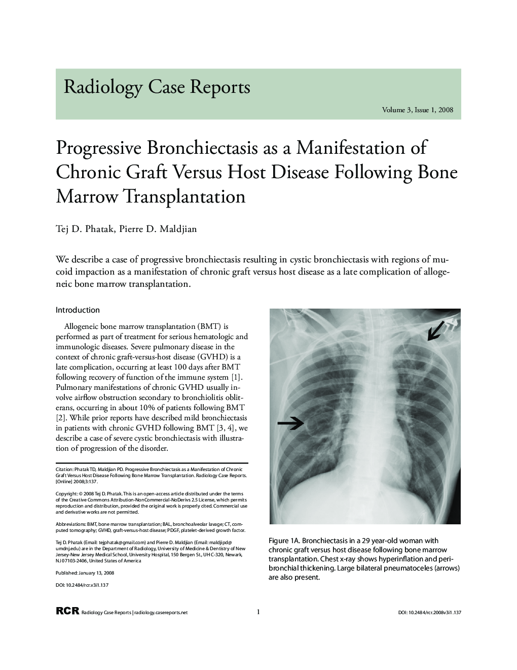 Progressive Bronchiectasis as a Manifestation of Chronic Graft Versus Host Disease Following Bone Marrow Transplantation