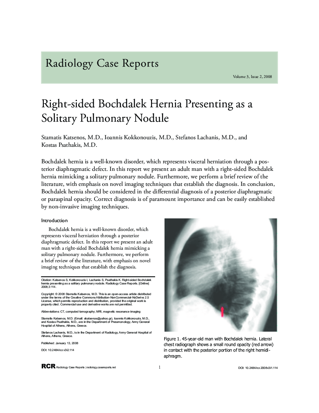 Right-sided Bochdalek Hernia Presenting as a Solitary Pulmonary Nodule