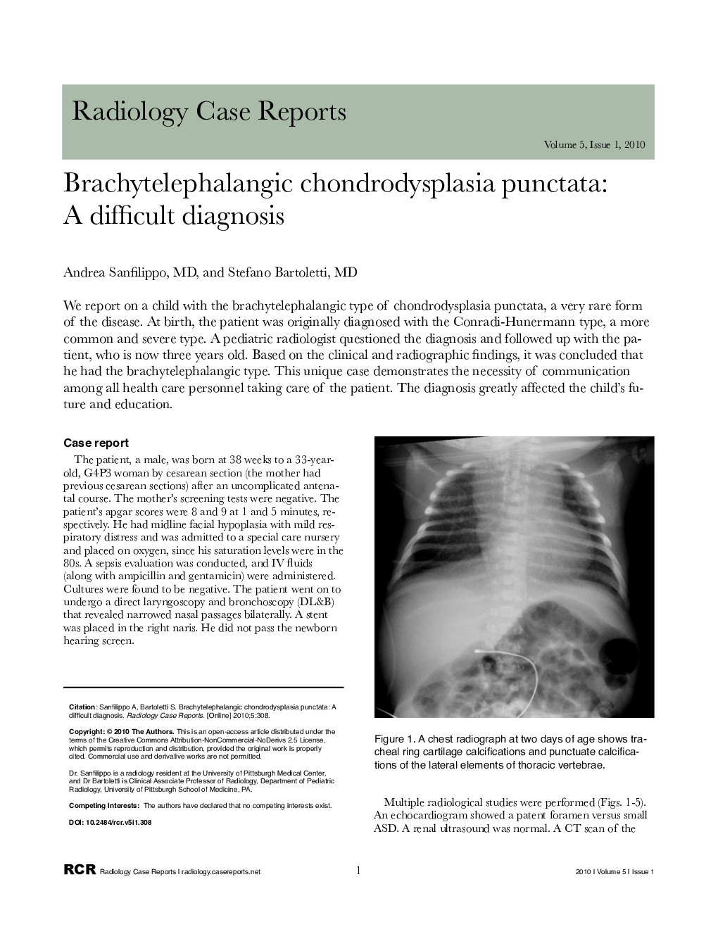 Brachytelephalangic chondrodysplasia punctata: A difficult diagnosis