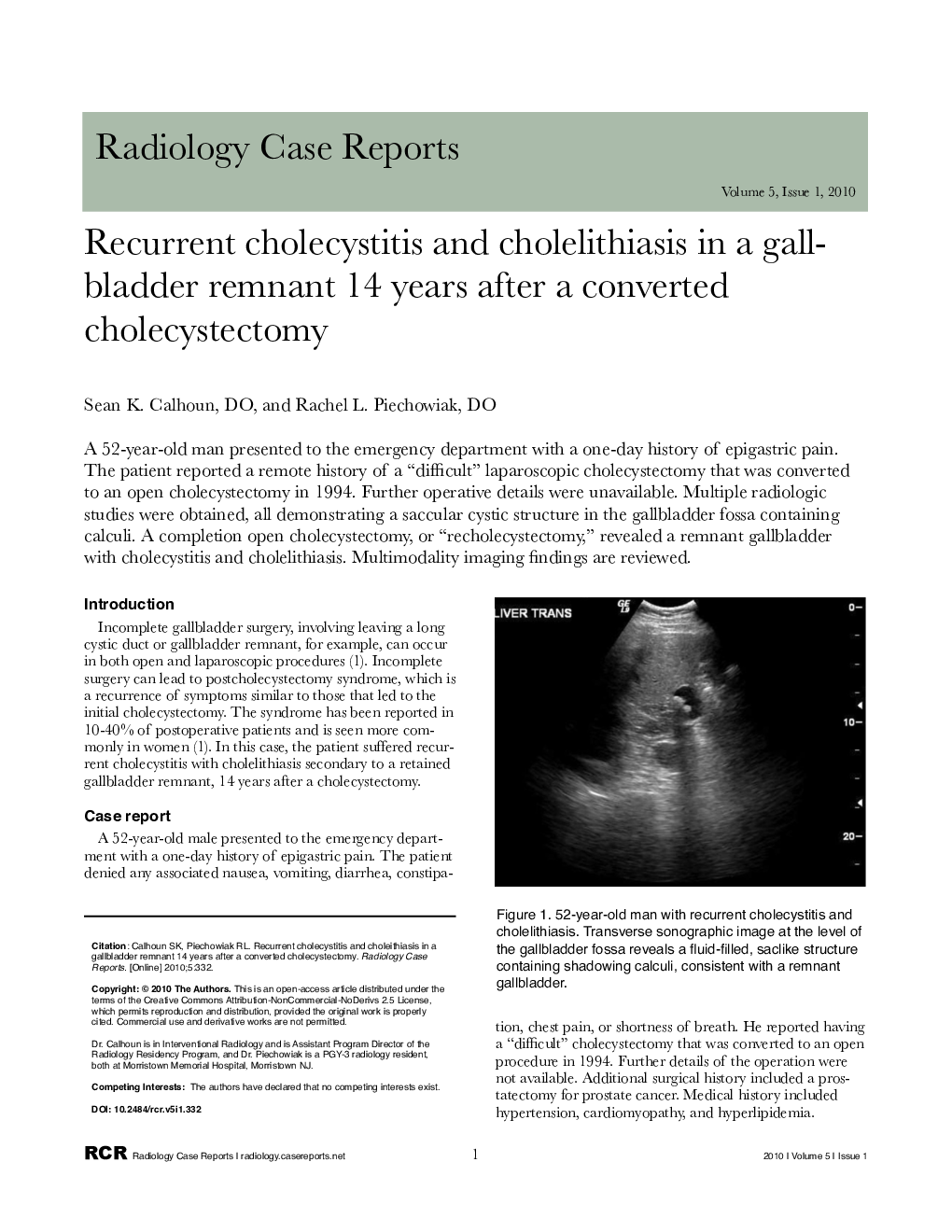 Recurrent cholecystitis and cholelithiasis in a gallbladder remnant 14 years after a converted cholecystectomy