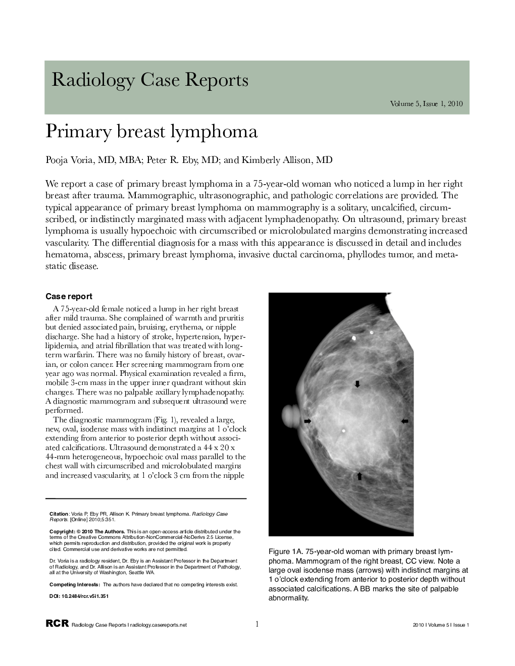 Primary breast lymphoma