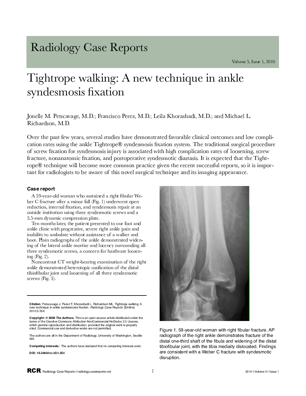 Tightrope walking: A new technique in ankle syndesmosis fixation