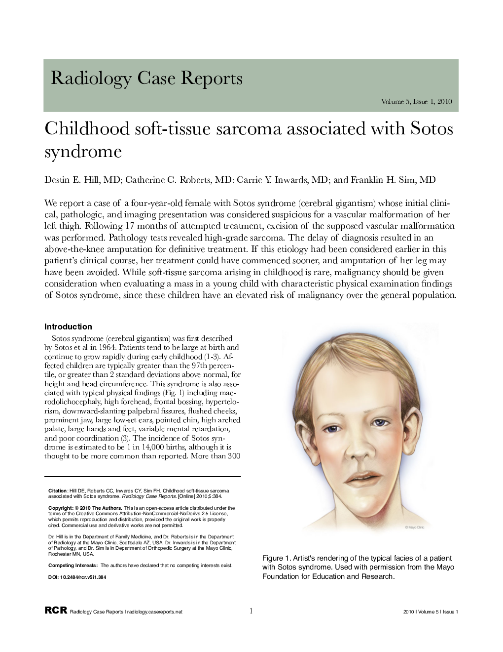 Childhood soft-tissue sarcoma associated with Sotos syndrome