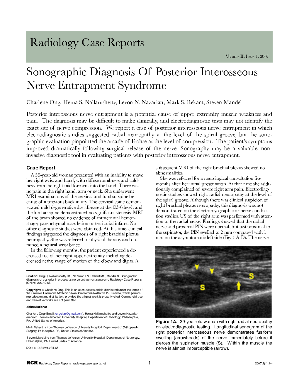 Sonographic Diagnosis Of Posterior Interosseous Nerve Entrapment Syndrome 