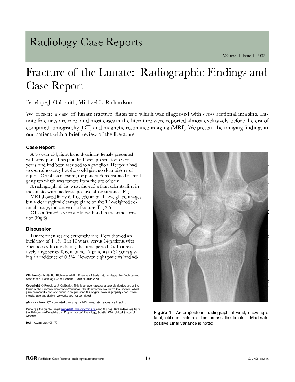 Fracture of the Lunate: Radiographic Findings and Case Report 