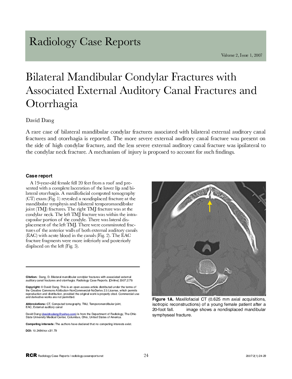 Bilateral Mandibular Condylar Fractures with Associated External Auditory Canal Fractures and Otorrhagia 