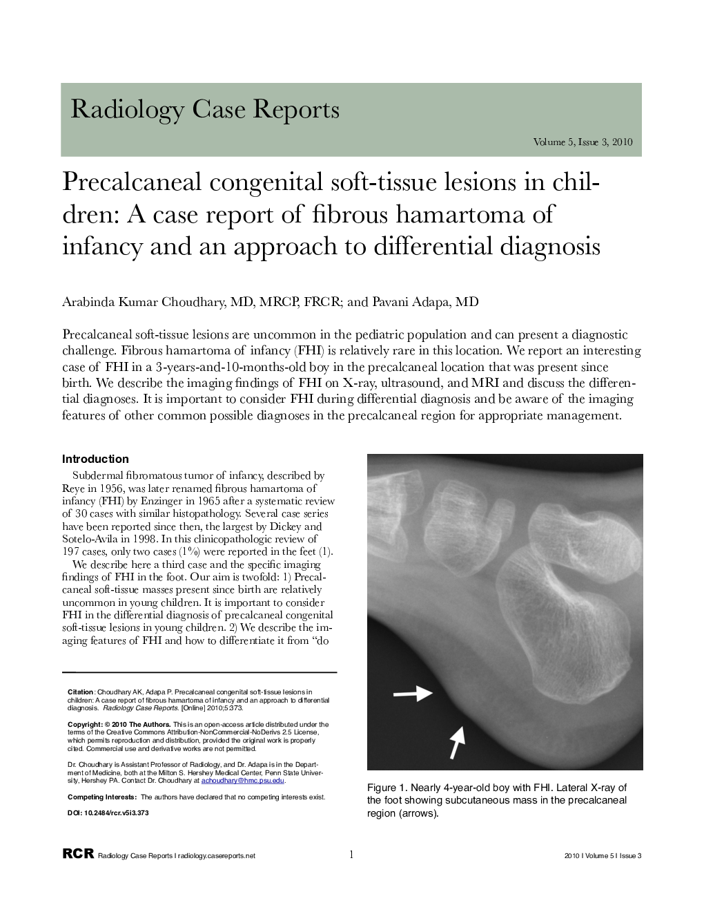 Precalcaneal congenital soft-tissue lesions in children: A case report of fibrous hamartoma of infancy and an approach to differential diagnosis