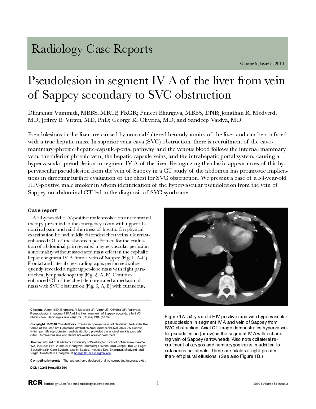 Pseudolesion in segment IV A of the liver from vein of Sappey secondary to SVC obstruction