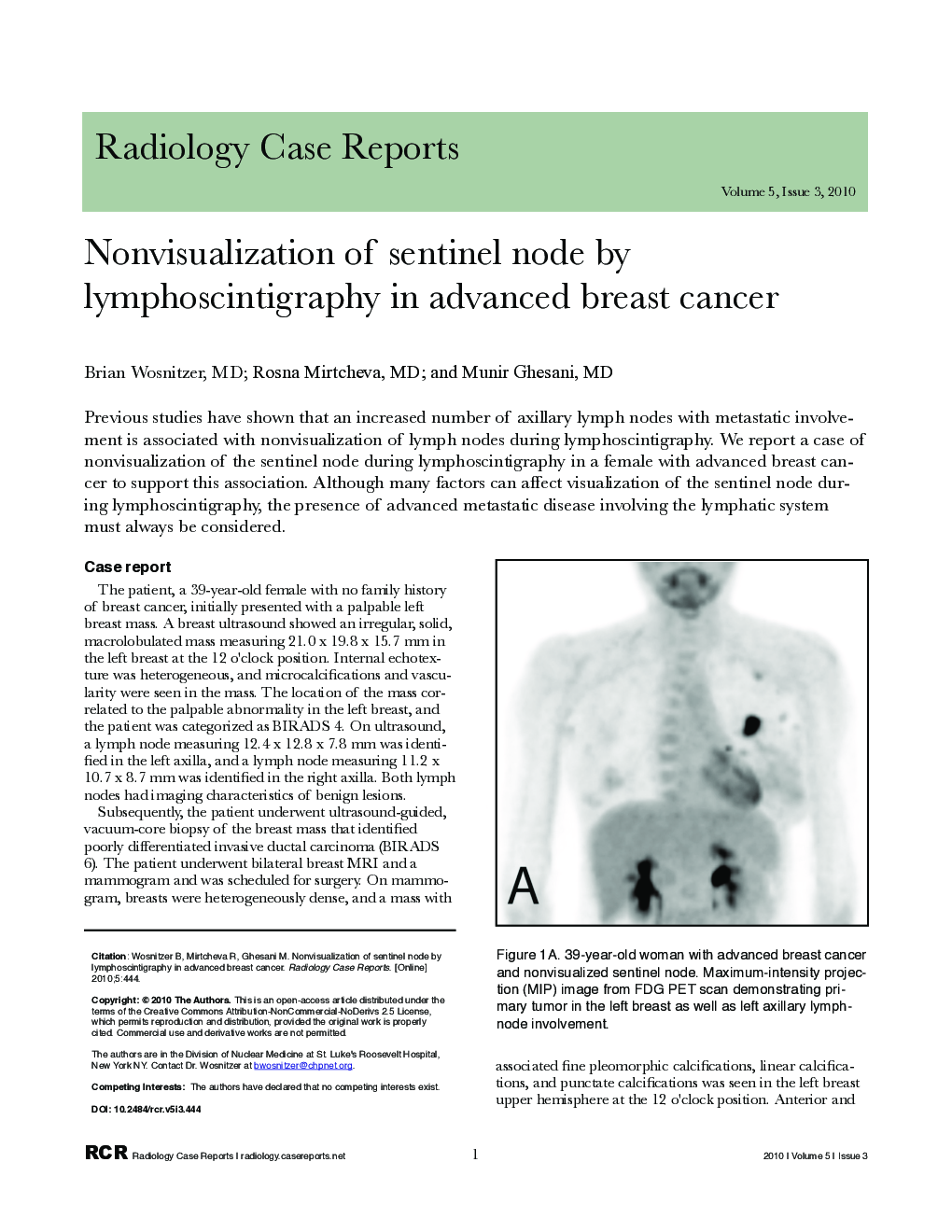 Nonvisualization of sentinel node by lymphoscintigraphy in advanced breast cancer