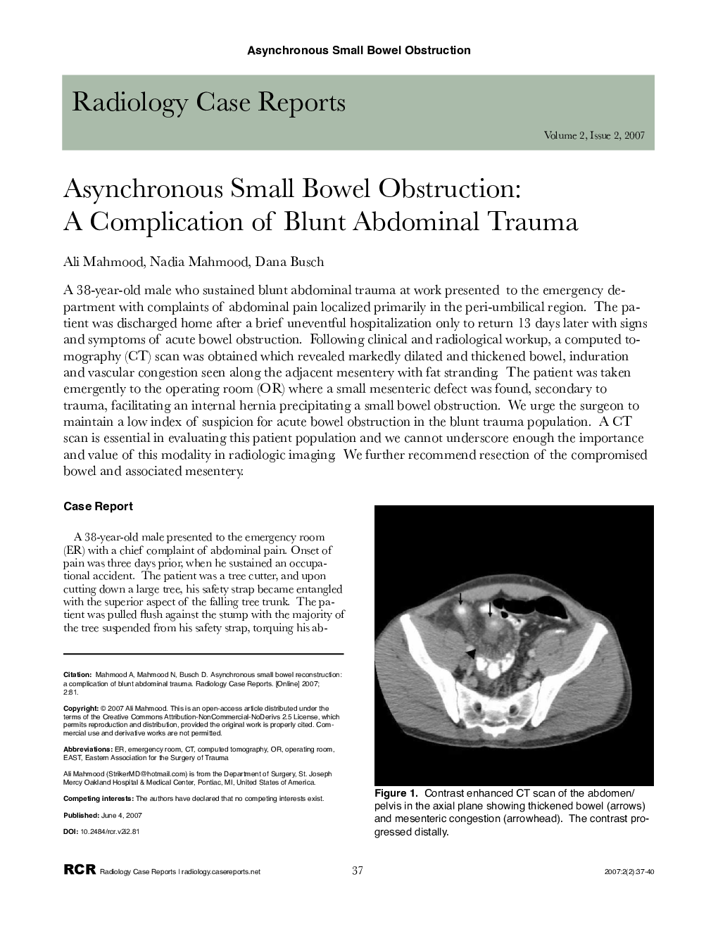 Asynchronous Small Bowel Obstruction: A Complication of Blunt Abdominal Trauma 