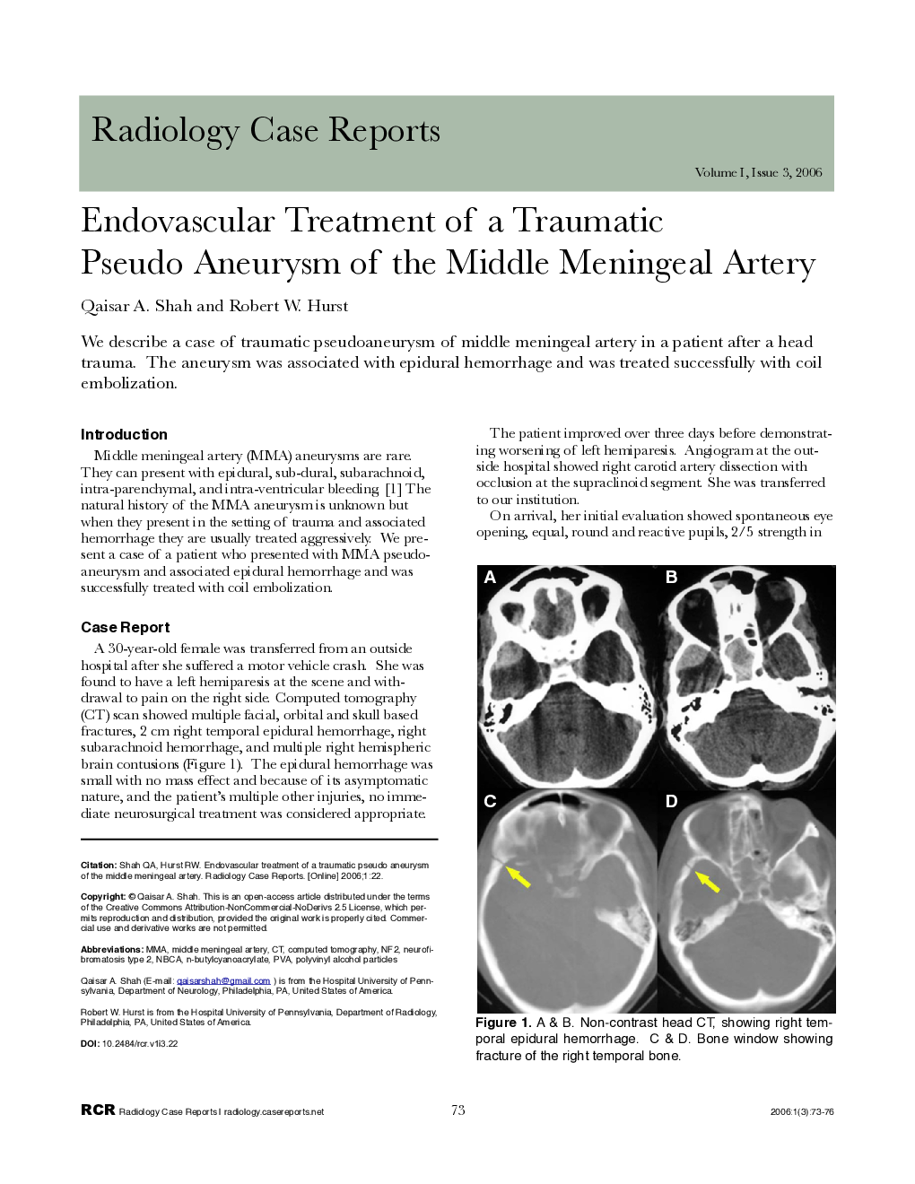 Endovascular Treatment of a Traumatic Pseudo Aneurysm of the Middle Meningeal Artery 