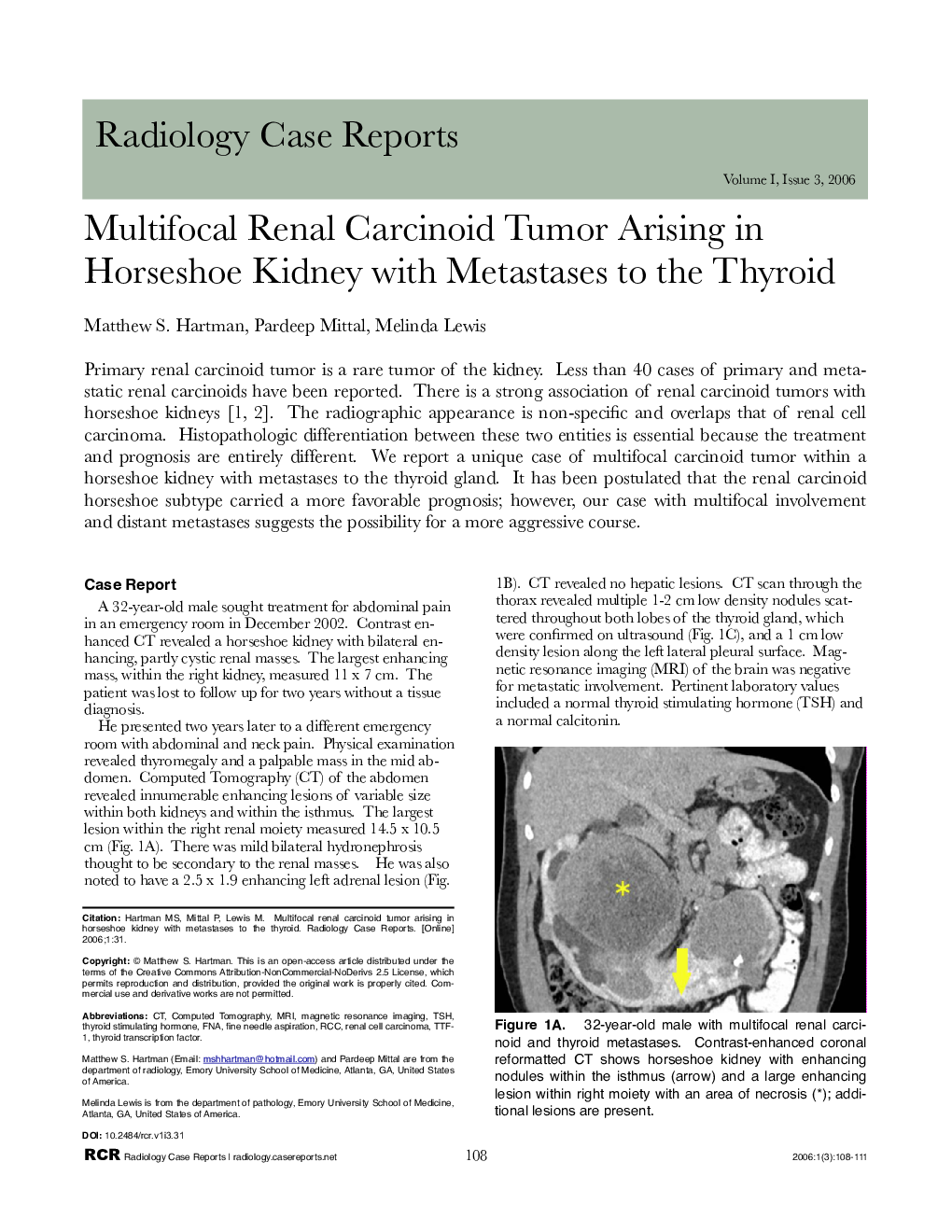 Multifocal Renal Carcinoid Tumor Arising in Horseshoe Kidney with Metastases to the Thyroid 