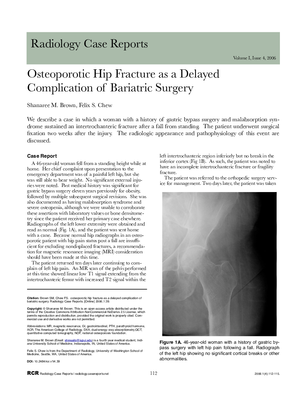 Osteoporotic Hip Fracture as a Delayed Complication of Bariatric Surgery 
