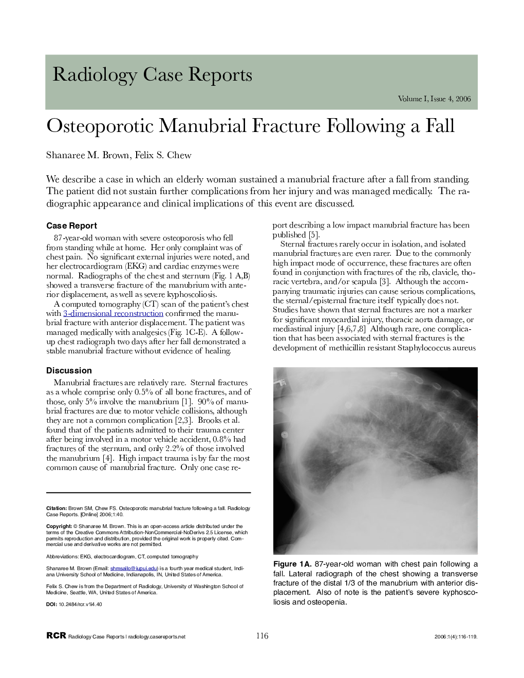 Osteoporotic Manubrial Fracture Following a Fall 