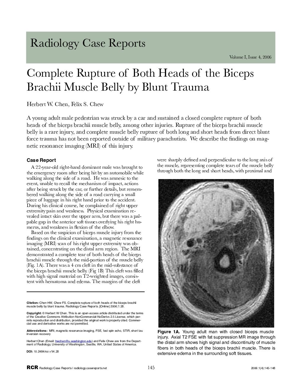 Complete Rupture of Both Heads of the Biceps Brachii Muscle Belly by Blunt Trauma 