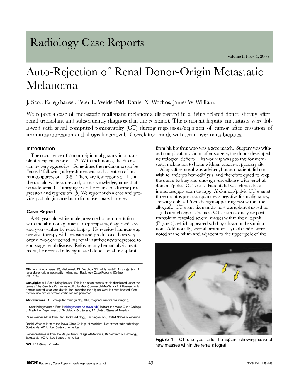 Auto-Rejection of Renal Donor-Origin Metastatic Melanoma 