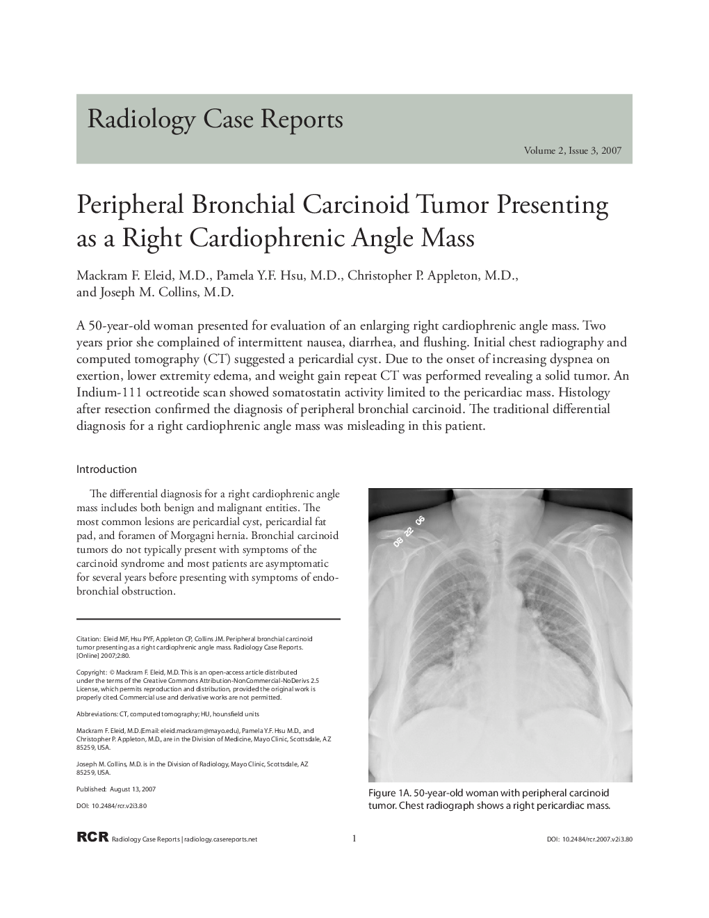 Peripheral Bronchial Carcinoid Tumor Presenting as a Right Cardiophrenic Angle Mass