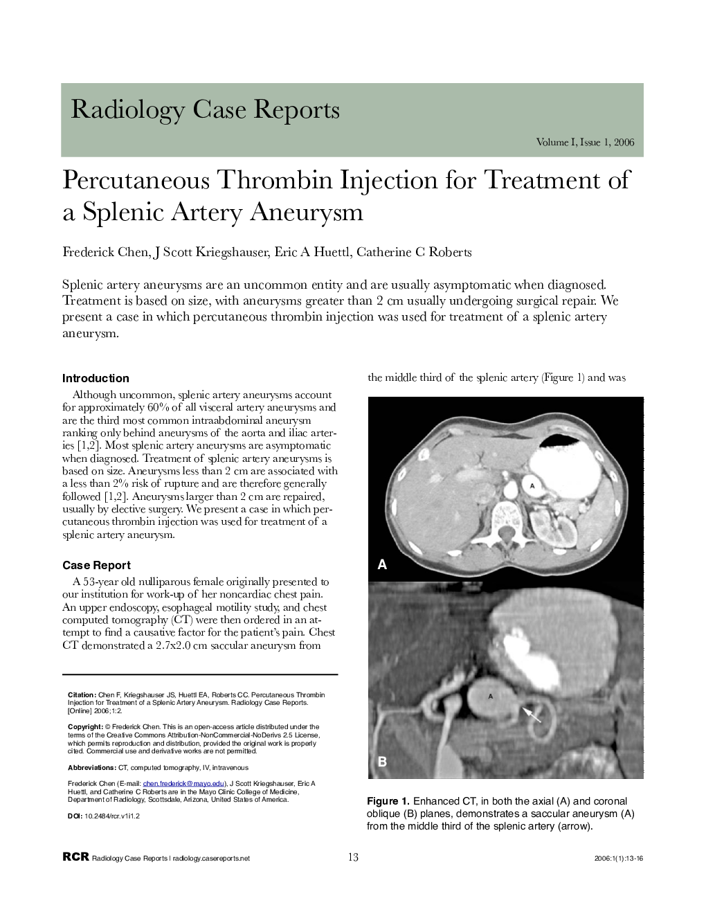 Percutaneous Thrombin Injection for Treatment of a Splenic Artery Aneurysm 