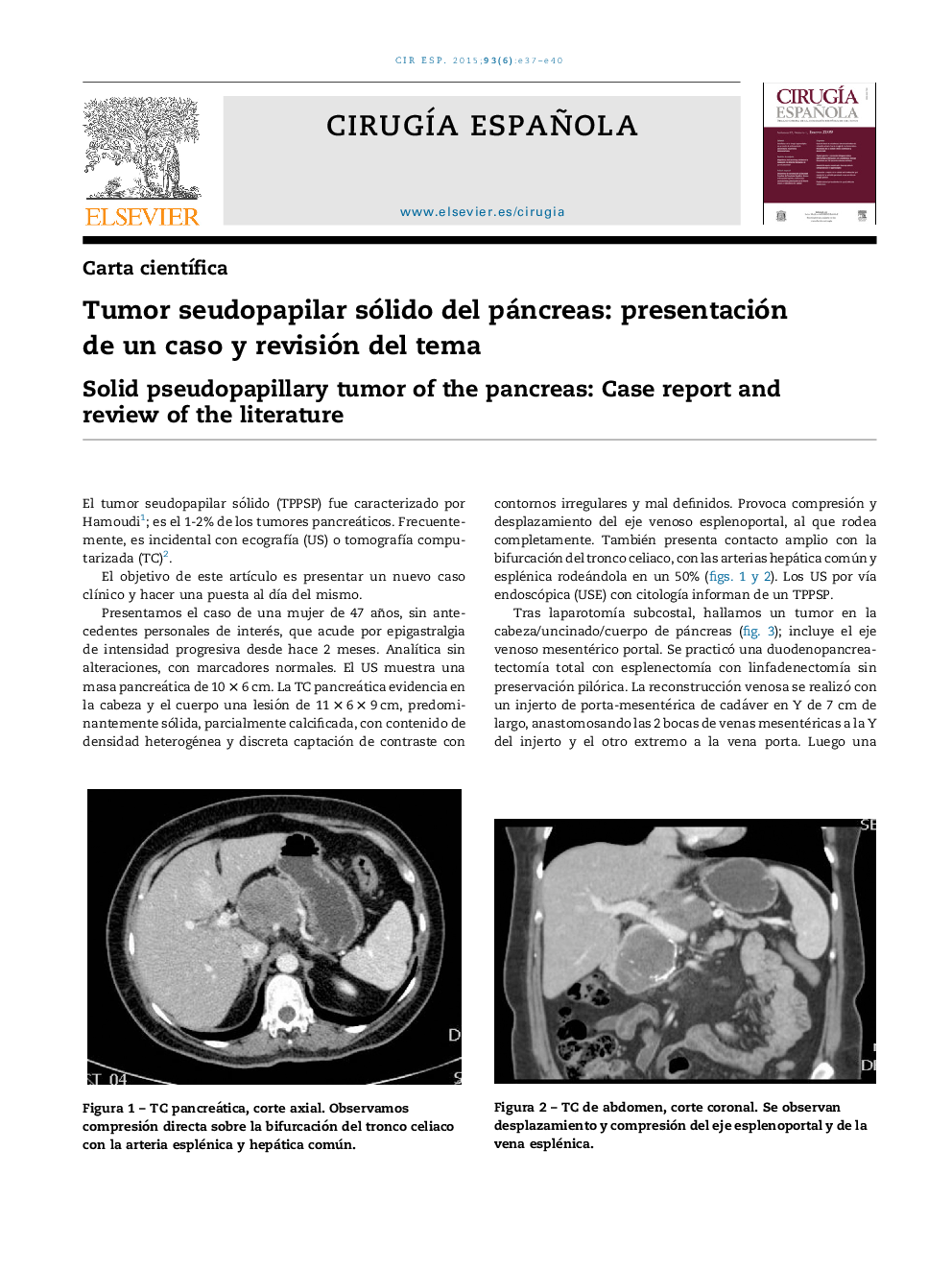 Tumor seudopapilar sólido del páncreas: presentación de un caso y revisión del tema