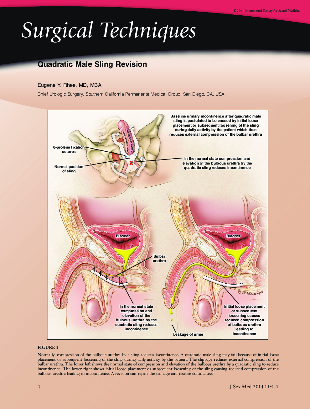Quadratic Male Sling Revision
