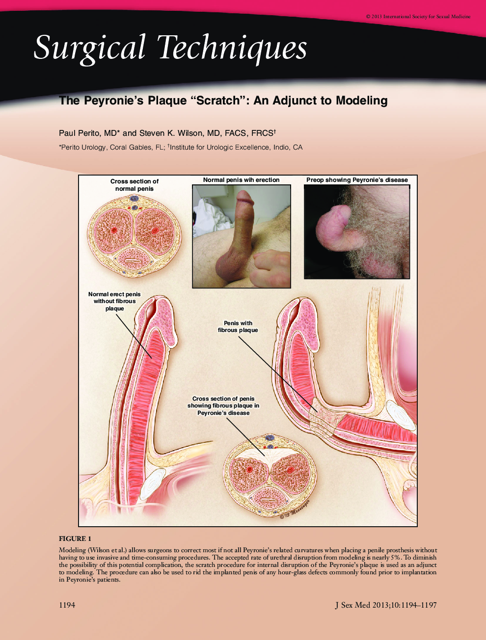 The Peyronie's Plaque “Scratch”: An Adjunct to Modeling