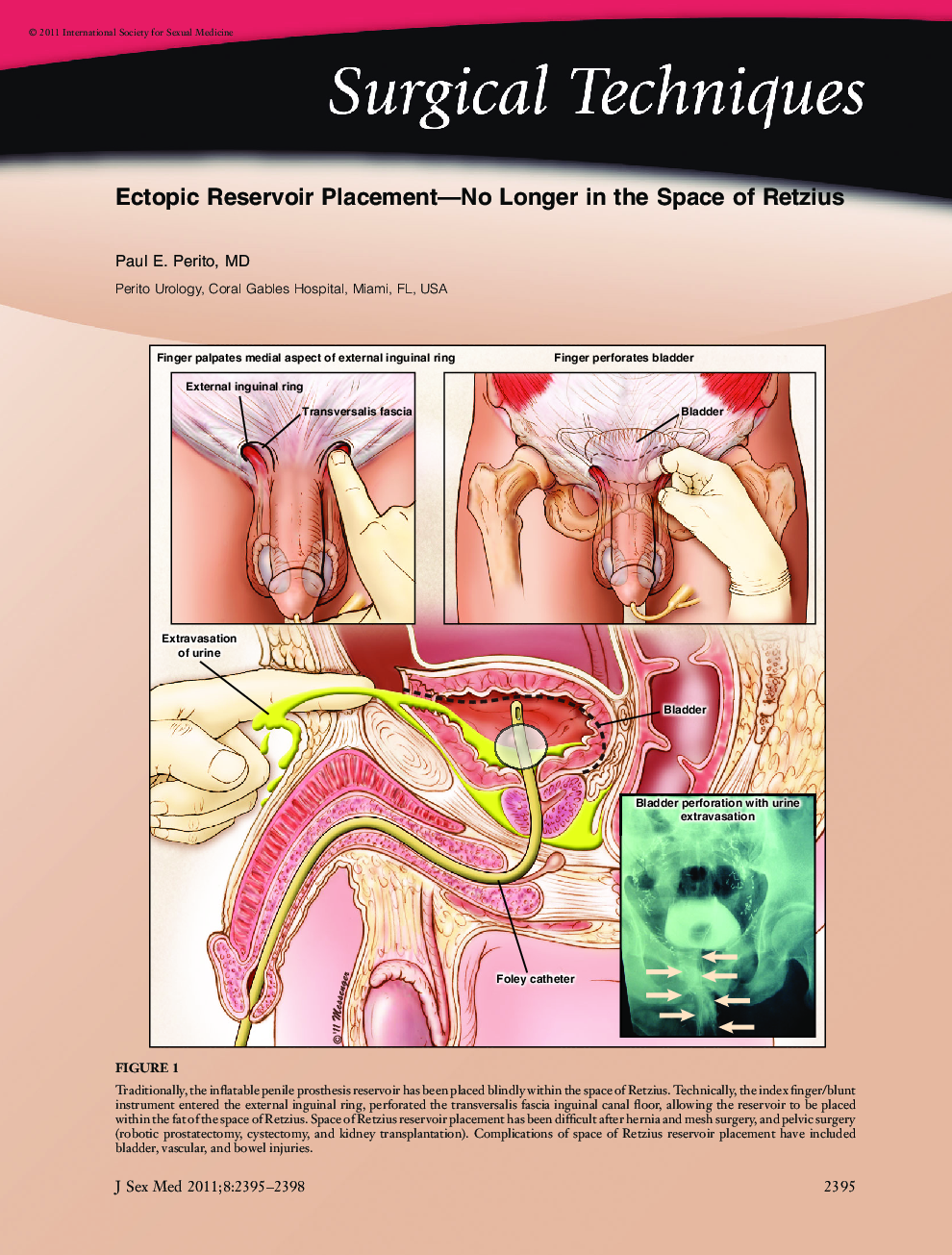 Ectopic Reservoir Placement-No Longer in the Space of Retzius