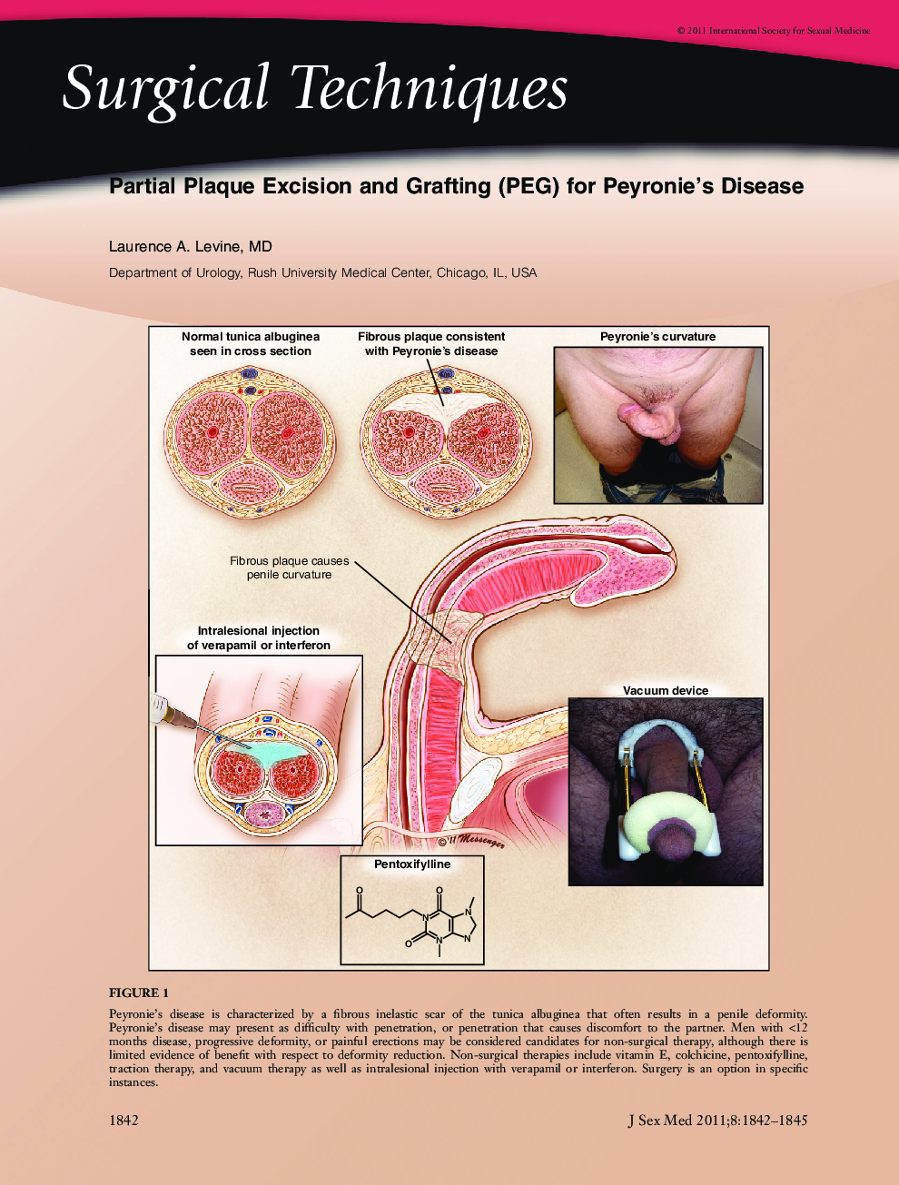 Partial Plaque Excision and Grafting (PEG) for Peyronie's Disease